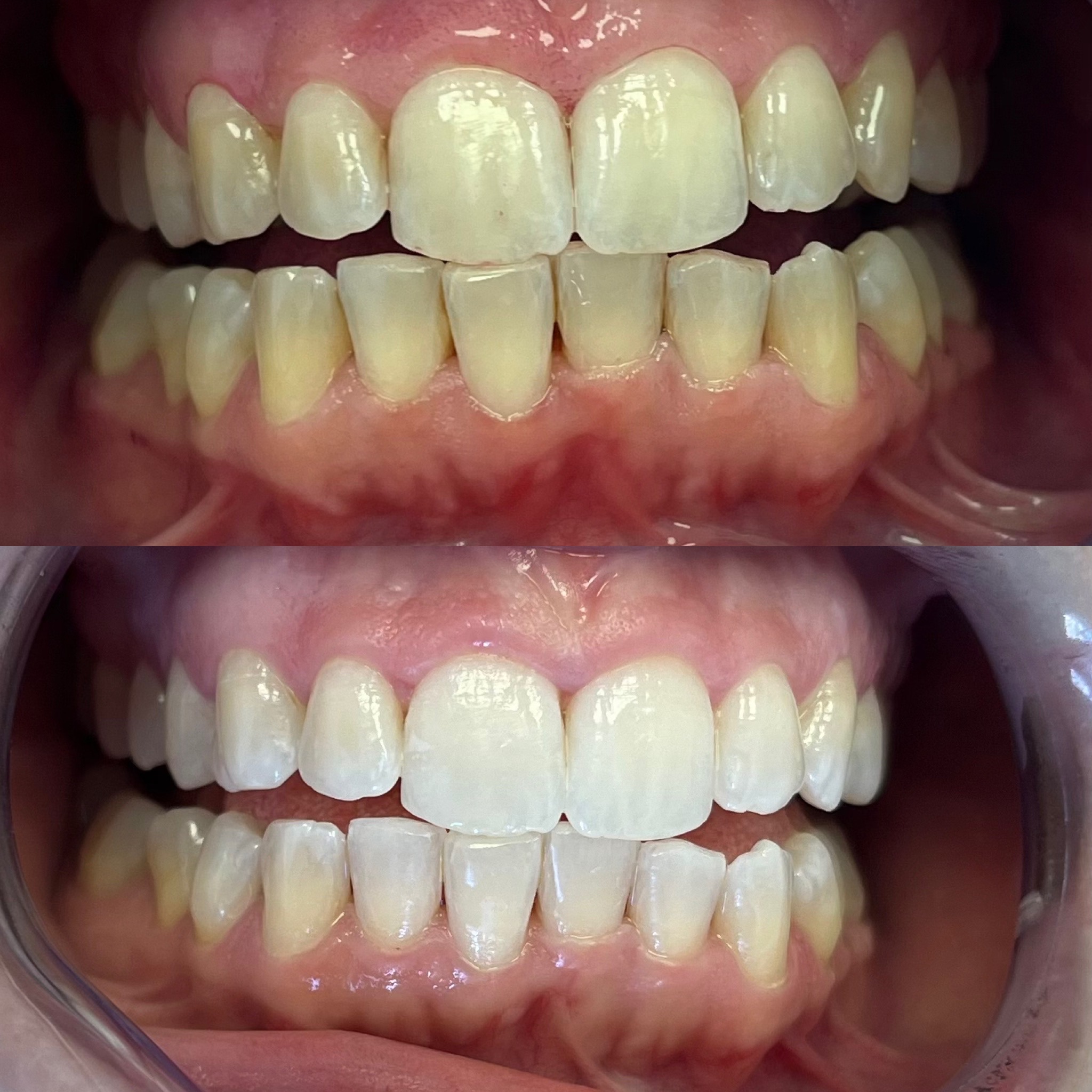 Sbiancamento dentale a Roma Aurelio